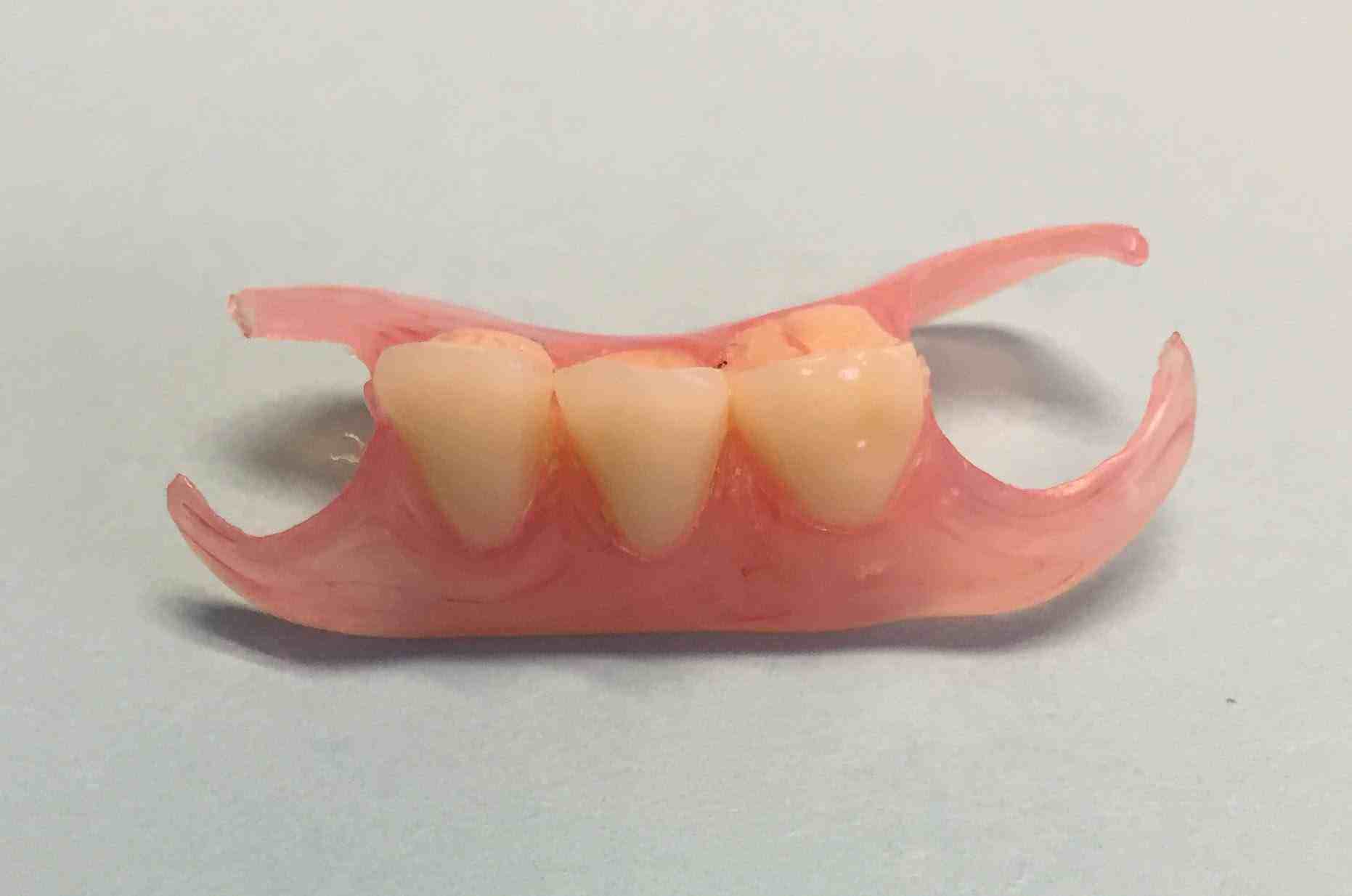 Valplast Flexible Partial Denture. Dr. Gentry