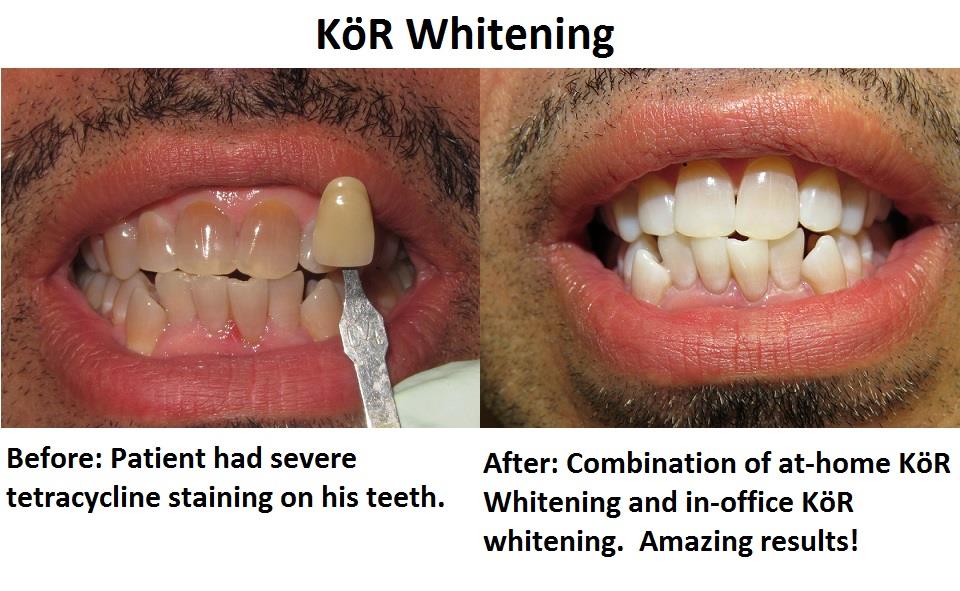 Simply Whiter Teeth with KöR Whitening Caring Smiles Family Dentistry