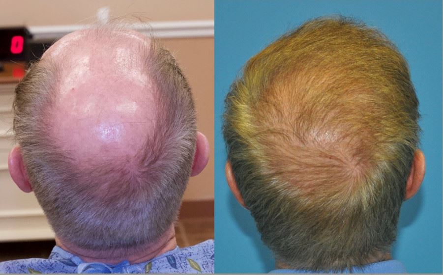 1 Session 5,000 FUE Hair Grafts for Norwood 6 Carolina Hair Surgery