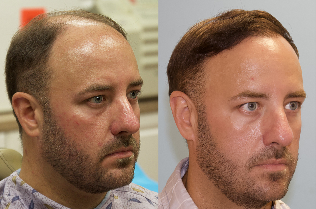 Frontal FUE Hair Transplant 2500 Grafts Carolina Hair Surgery