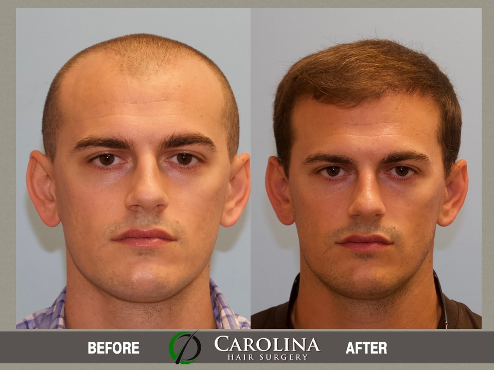 26 Year Old Male With Norwood Class 4 Hair Loss Carolina Hair Surgery