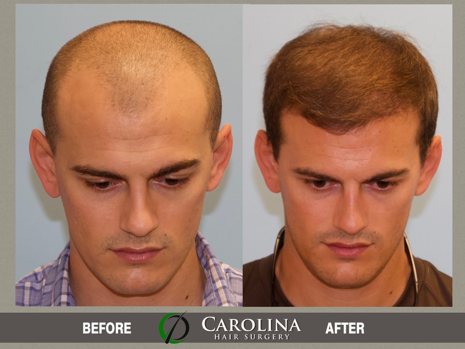 26 Year Old Male With Norwood Class 4 Hair Loss Carolina Hair Surgery