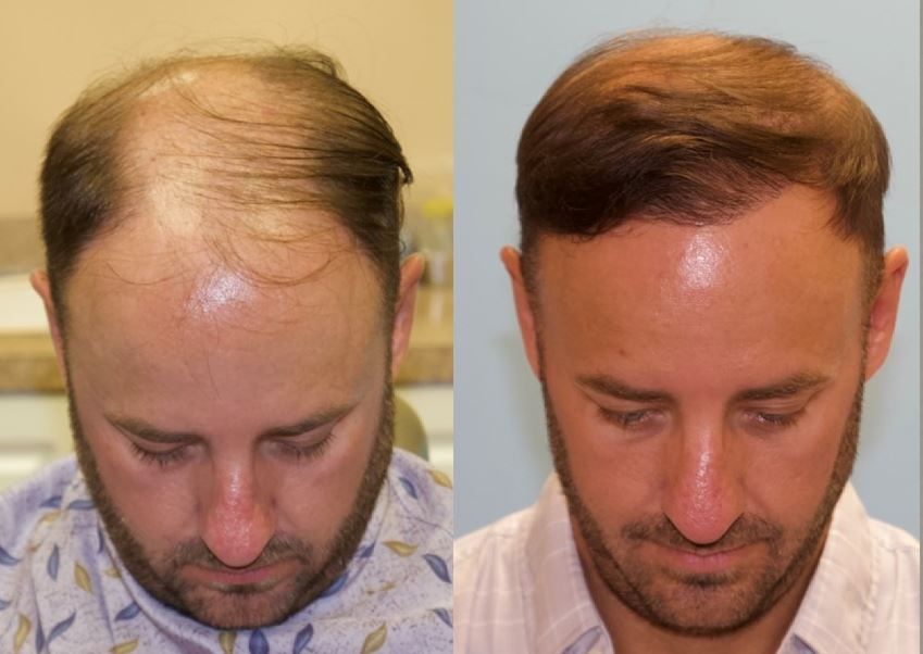 Frontal FUE Hair Transplant 2500 Grafts Carolina Hair Surgery