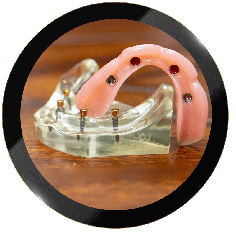 Full Mouth Dental Implants Durham & Raleigh, NC Periodontics