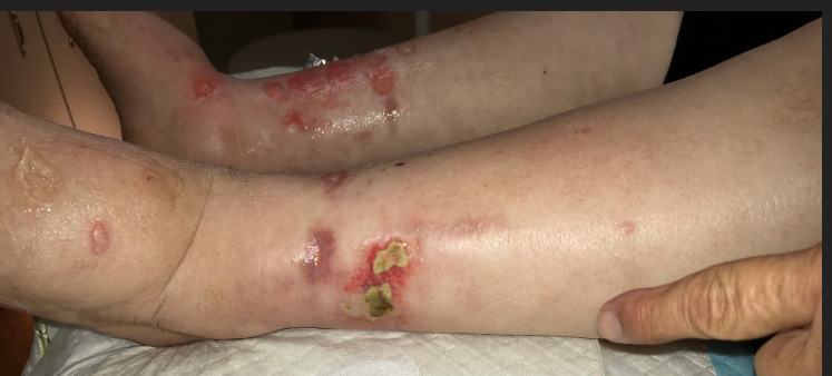 Don't Miss This Chronic Ulcers Due to Influenza? Sort of… Caroline