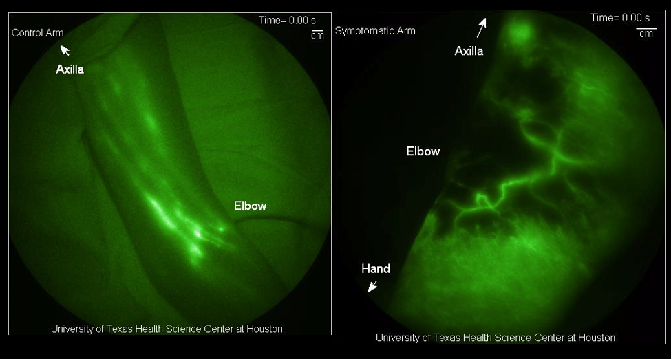 The (Mostly) Complete Guide to Lymphatic Anatomy Part 1 Why We Need