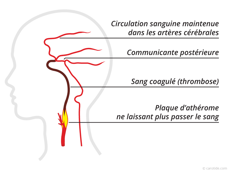 Formation et évolution d’une plaque d’athérome