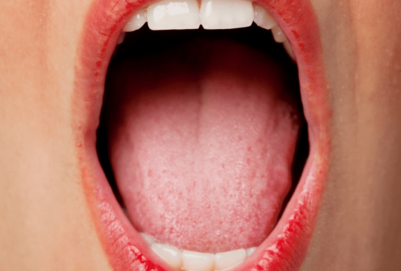 Dry Mouth Everything you need to know Carstairs Dental