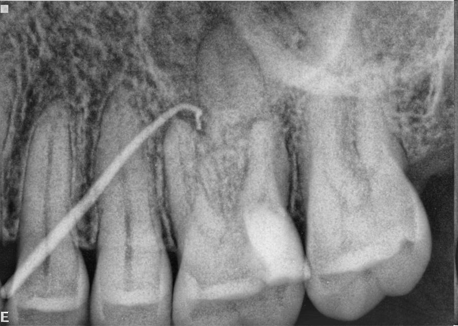 Surgical Tract Or Track at Justin Jimenez blog