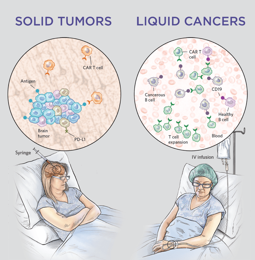 The Next Frontier of CART Cell Therapy Solid Tumors Cartherics