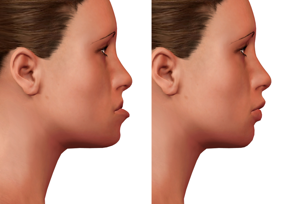 Jaw Surgery Jaw Surgery Lake Oswego Oral Surgeon Near Me 97035