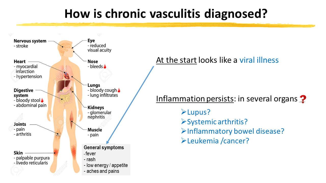 Vasculitis Cassie and Friends Society