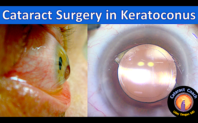 Cataract Surgery in Keratoconus Cataract Coach