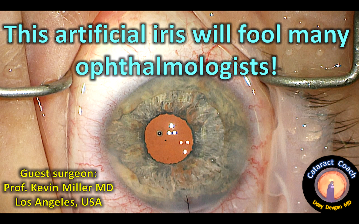 Artificial Iris Implants Cataract Coach