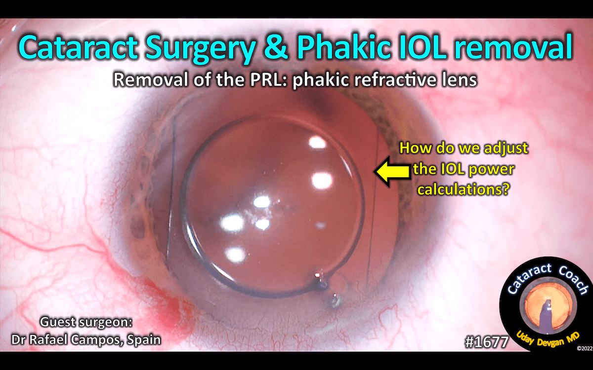 1677 cataract surgery & phakic IOL removal Cataract Coach™
