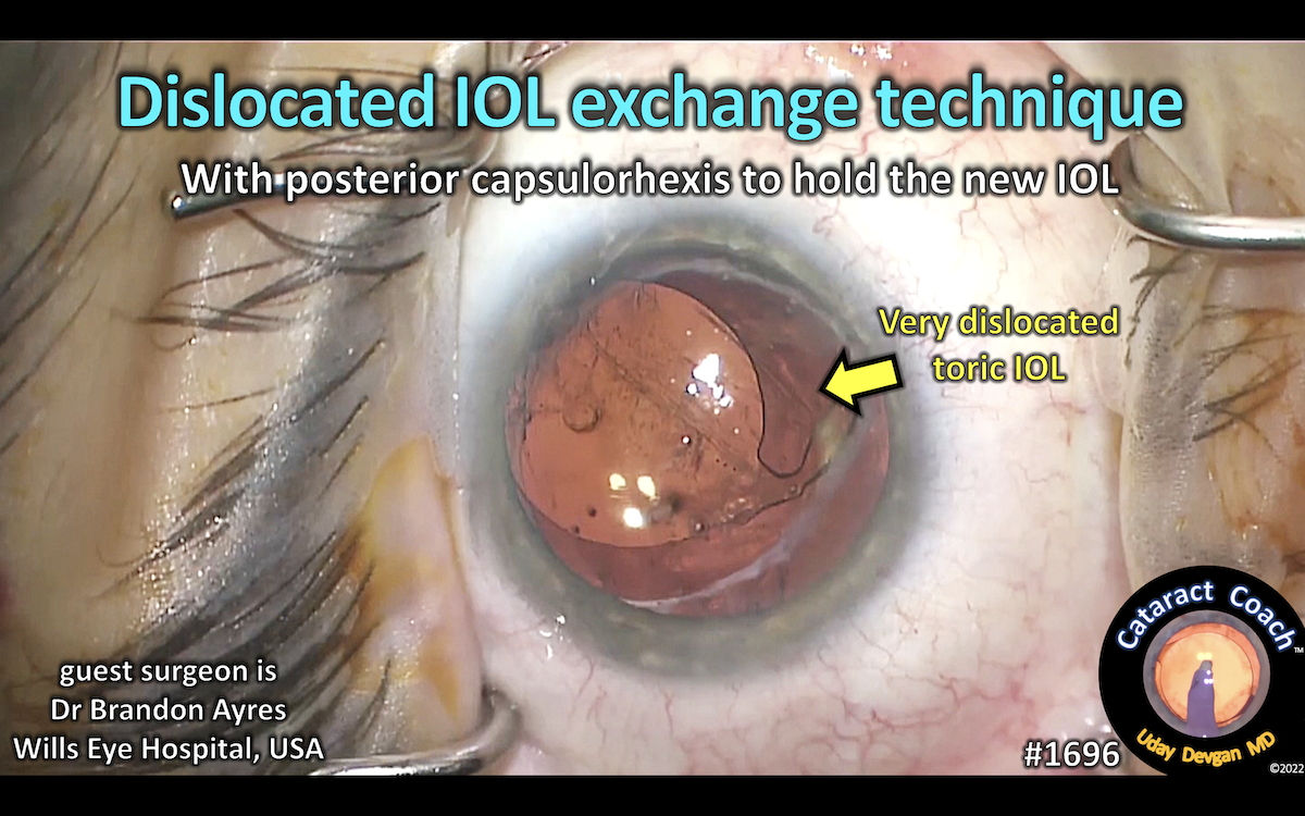 1696 dislocated IOL exchange technique Cataract Coach™