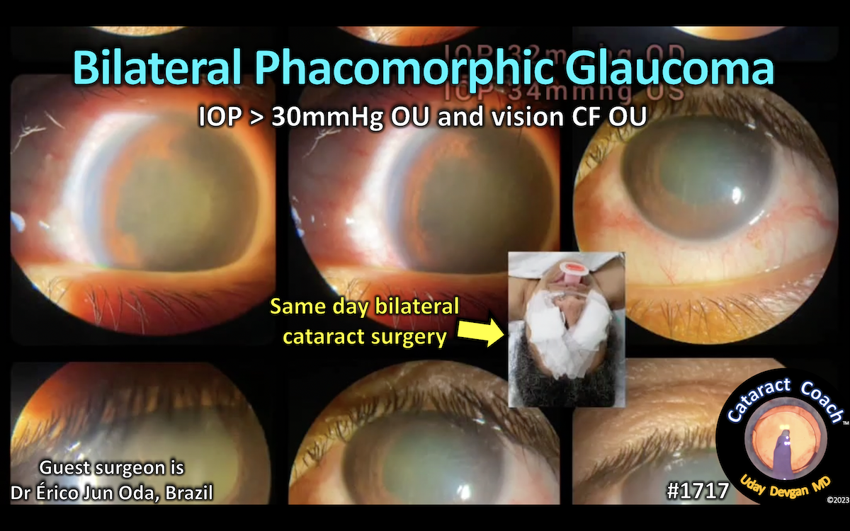 1717 bilateral Cataract Coach™