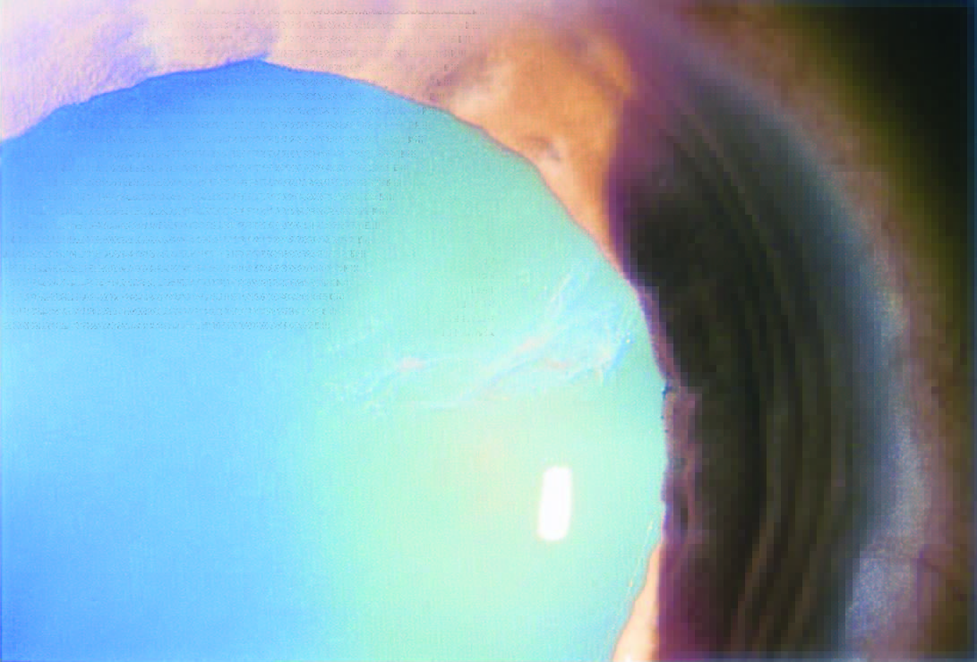 Snowflake Cataract Diabetes DiabetesWalls