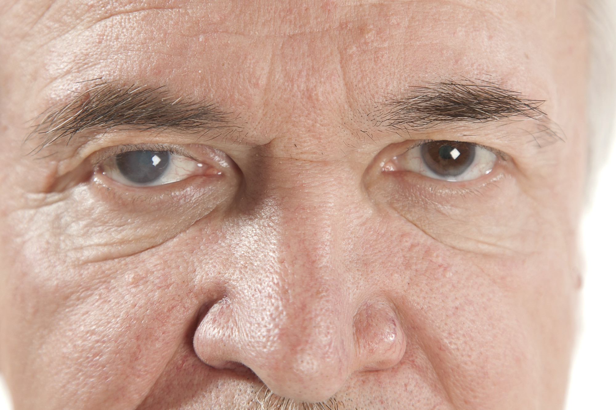 Bilateral Cataracts Signs, Causes and Treatment Options