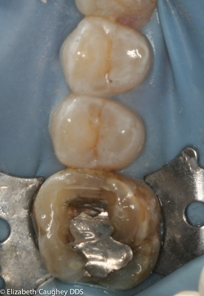 Decay under amalgam filling is typical Elizabeth Caughey