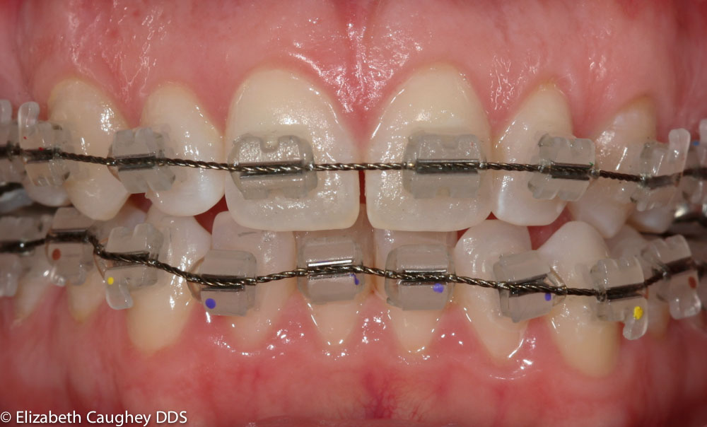 Holistic TMJ, Migraine Treatment Elizabeth Caughey DDSElizabeth