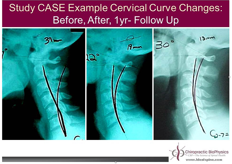 Improvement In Neck Curve and Posture Using the Denneroll Improves Neck