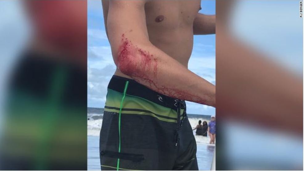 There were two shark attacks off the coast of Florida this weekend