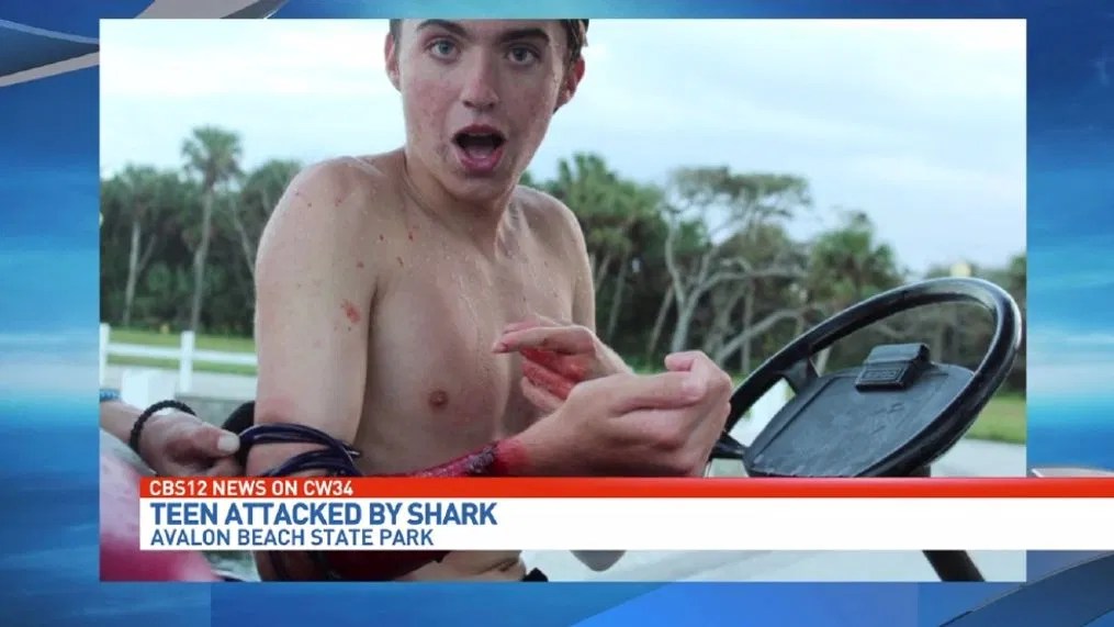 Wearing shark repelling band, Teen gets attacked by shark