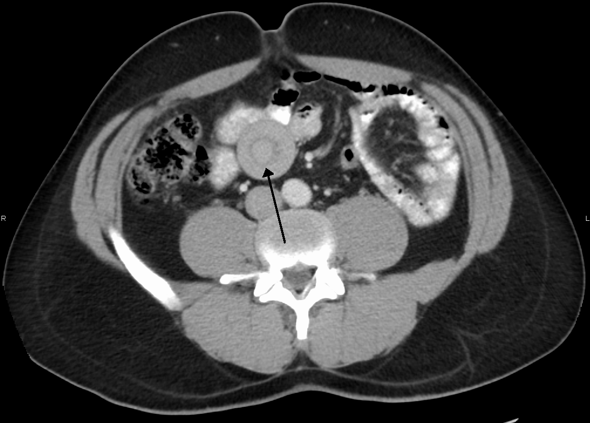 Intussusception Conway Homer, P.C.