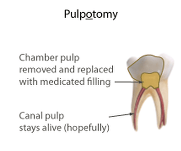 Pulp Therapy Broken Down
