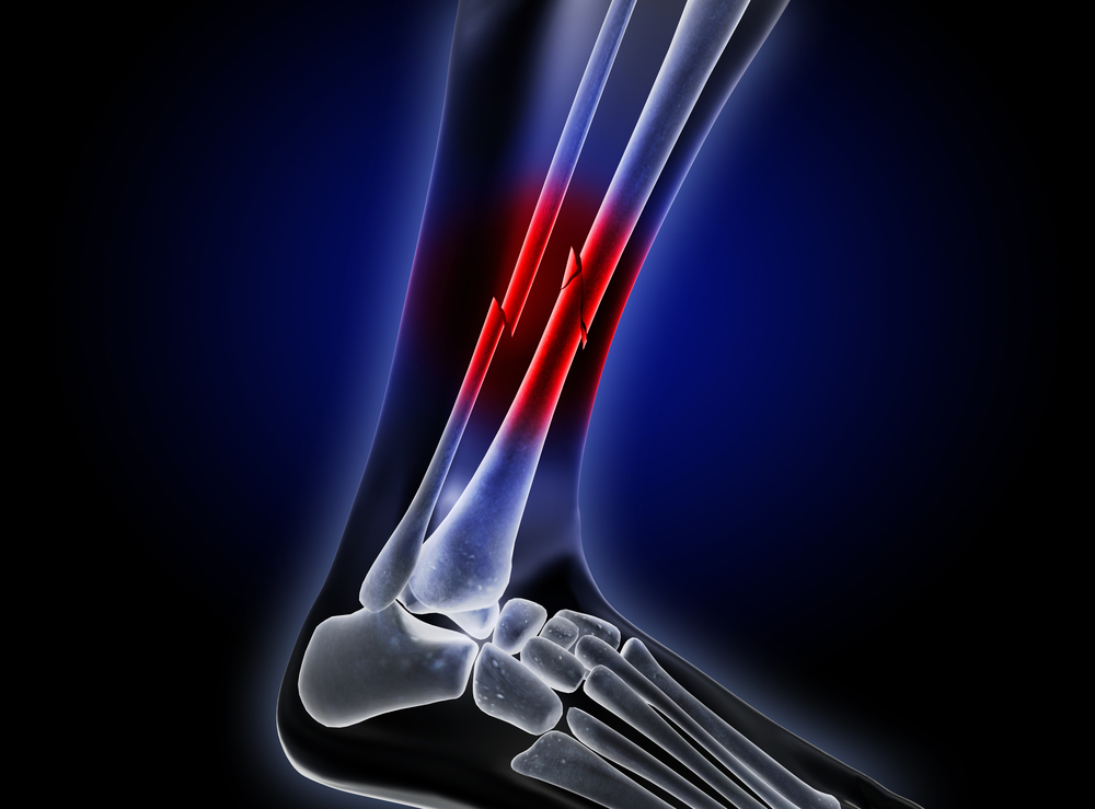 Broken Leg Bones How a Spokane Personal Injury Lawyer Can Help
