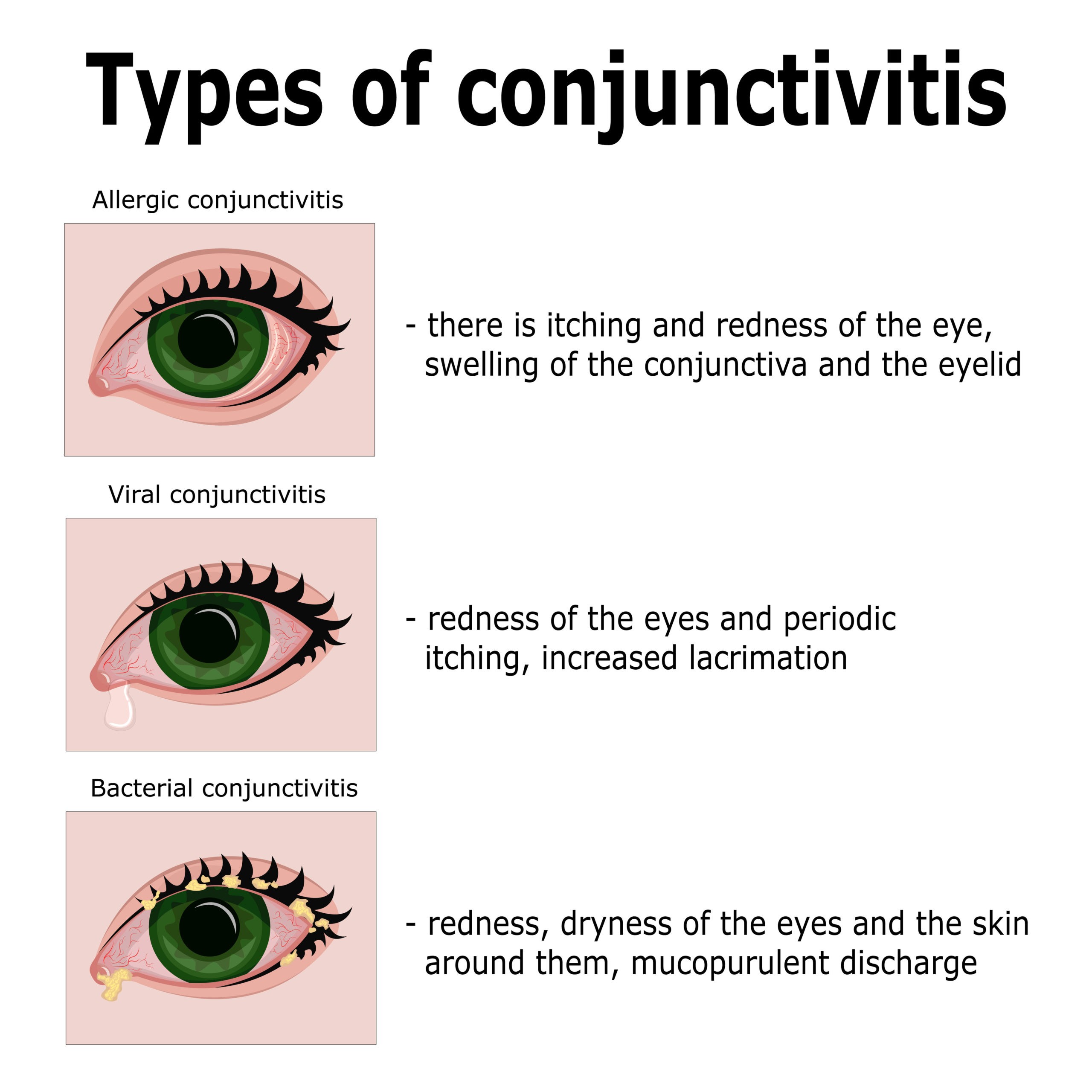 Conjunctivitis VA Disability Ratings Explained CCK Law