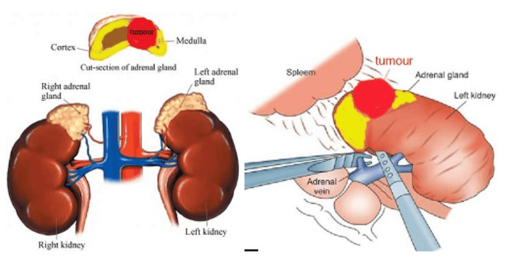 Robotic/Laparoscopic Adrenalectomy Chin Chong Min Urology & Robotic Surgery Centre