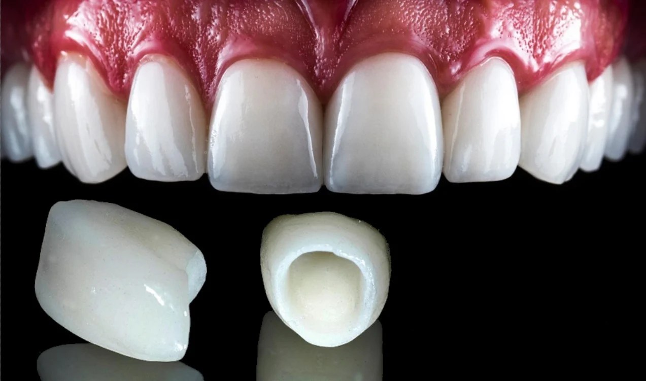 Zirconia Crown vs Emax Crown Which is The Best Option?