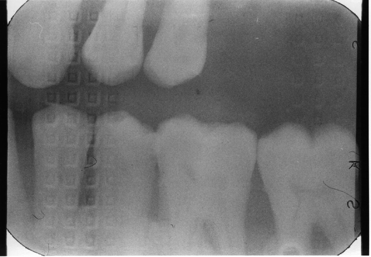 Radiographic In Dental Radiography Errors