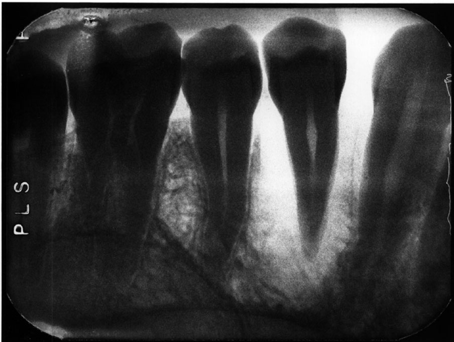 Radiographic In Dental Radiography Errors