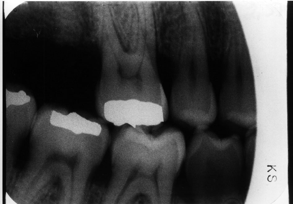 Radiographic In Dental Radiography Errors
