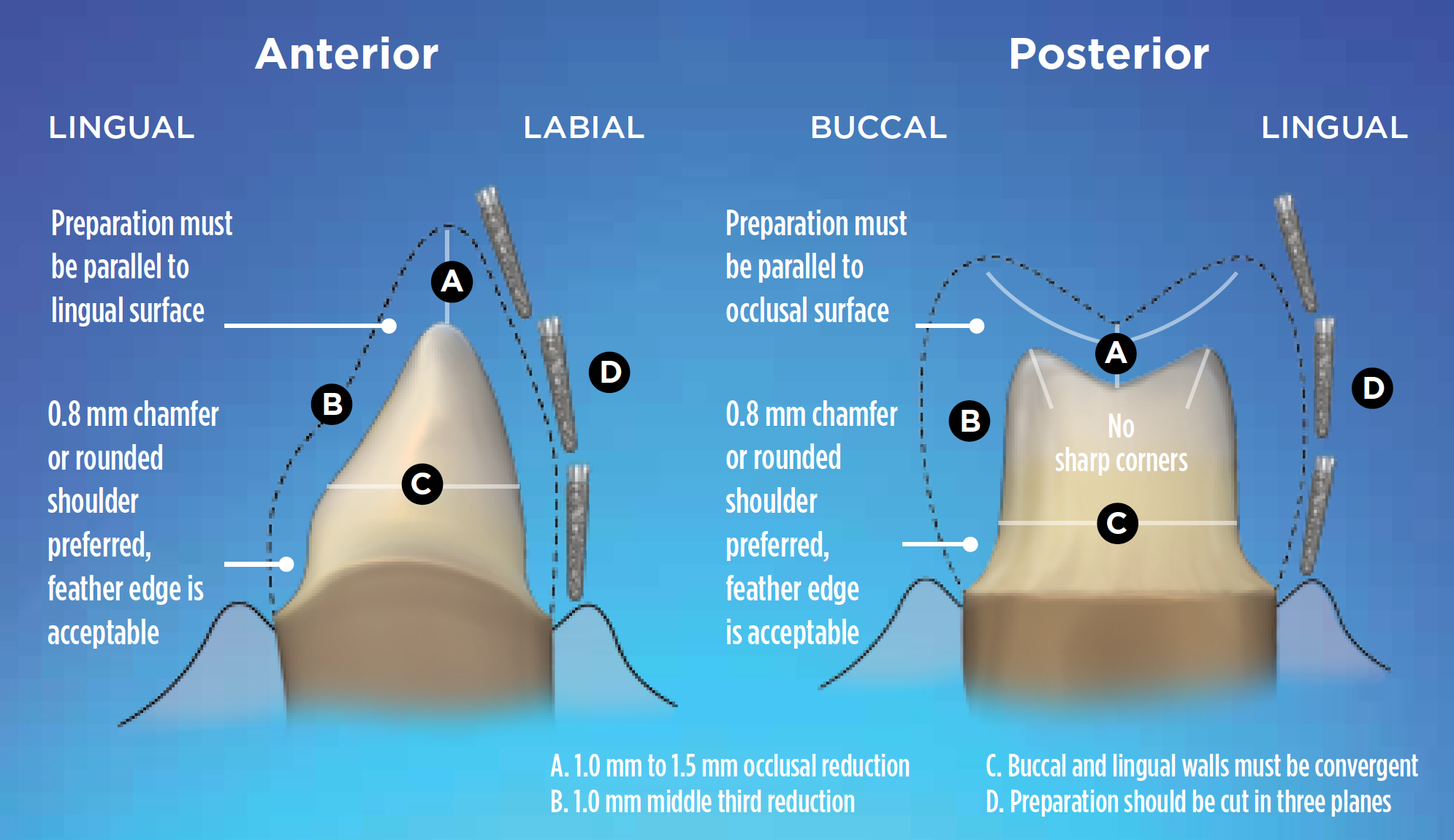 Zirconia Crowns Preparation