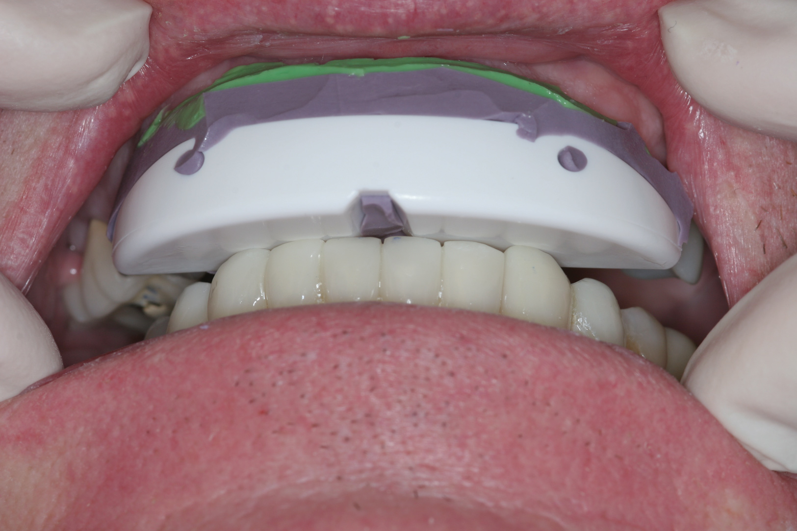 Tmj Splint Types FredericWinnie