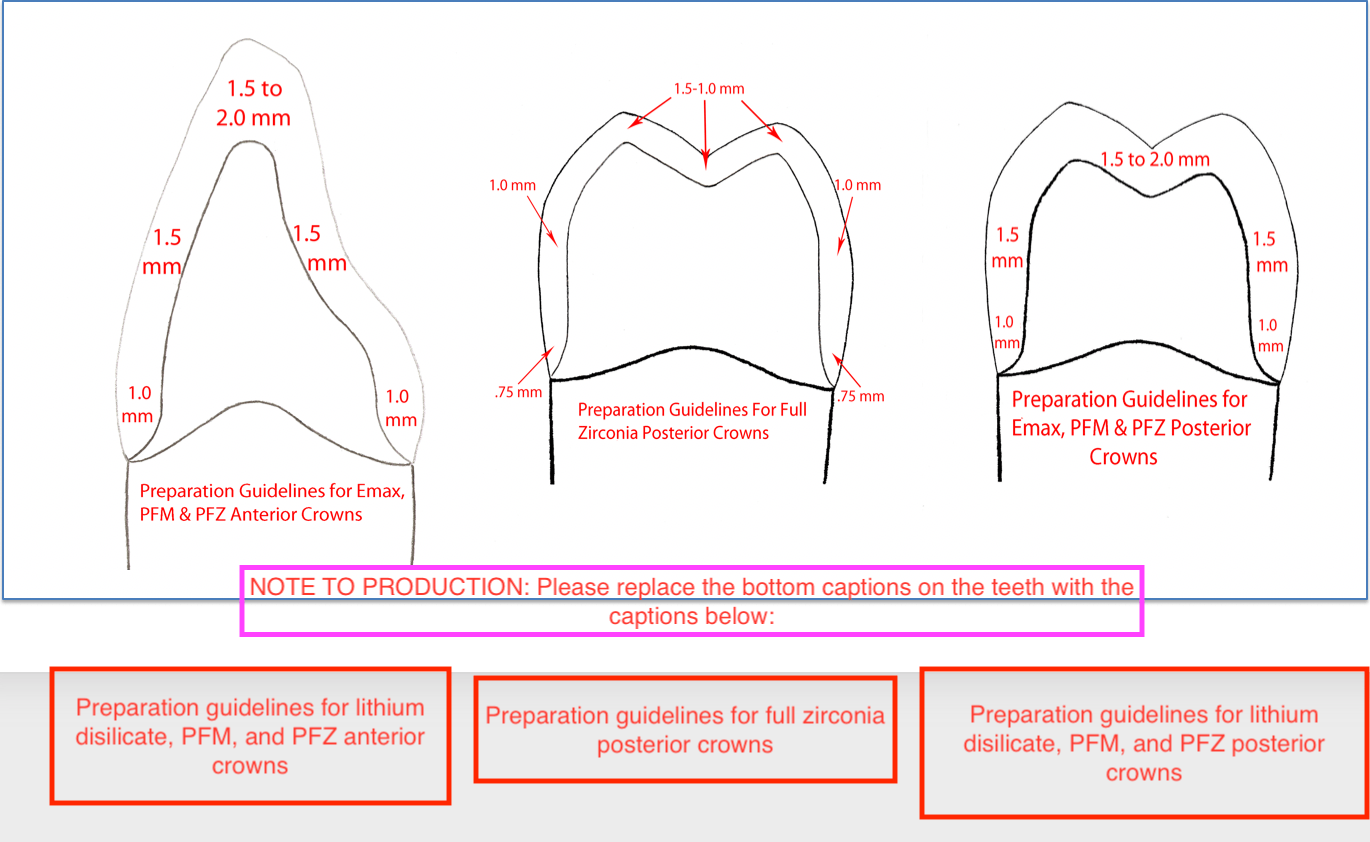 The Effect Of Preparation Taper On The Resistance To, 50 OFF