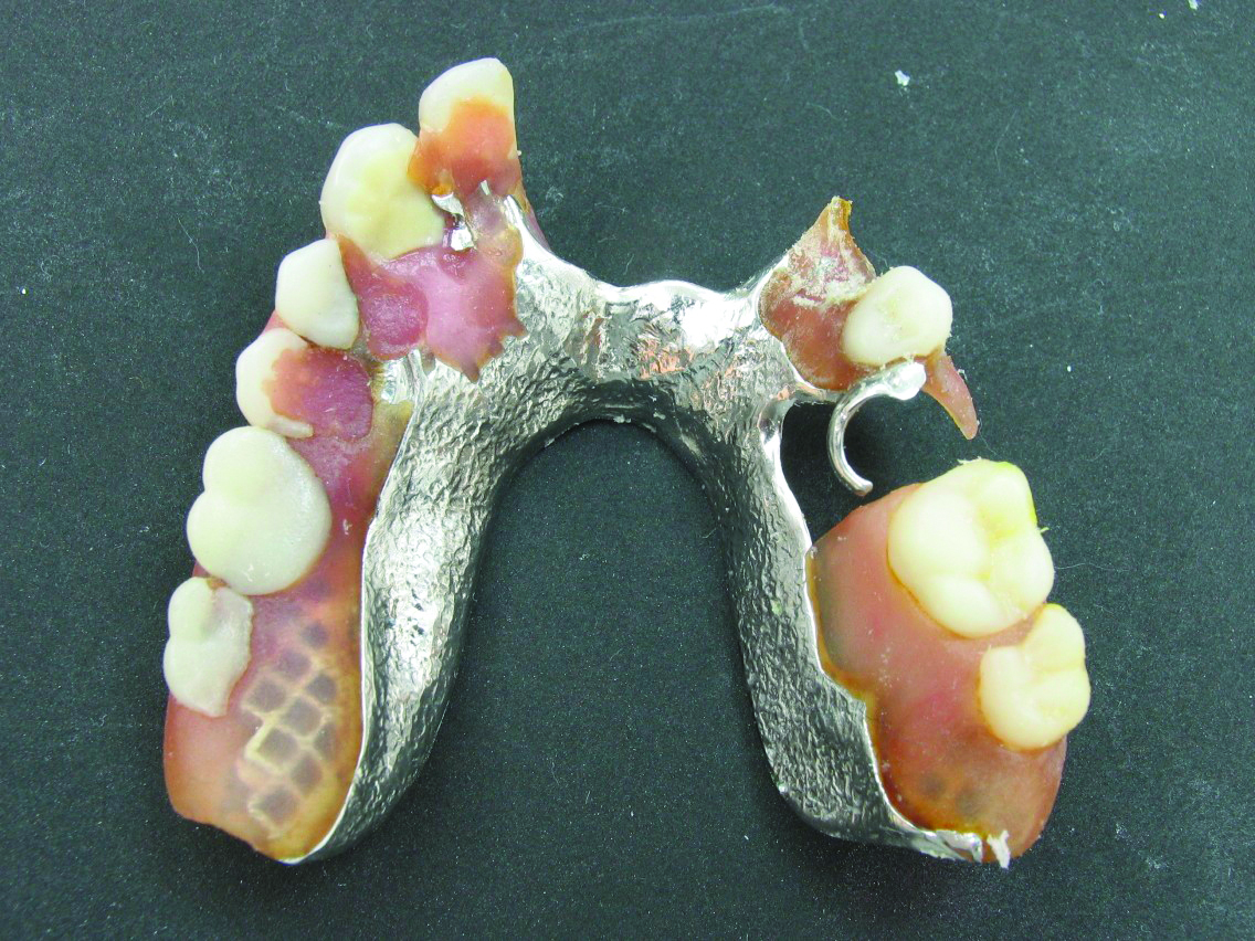 horseshoe partial denture design vansvangoghline
