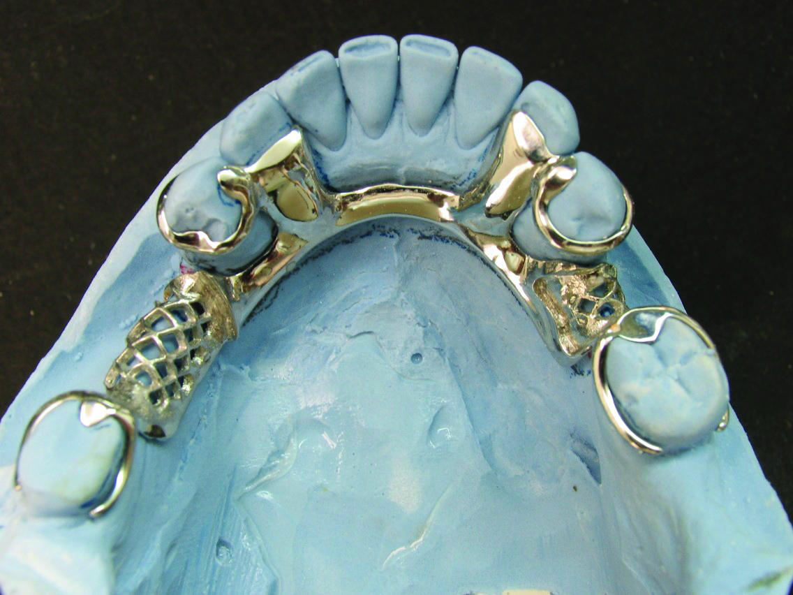 Литье бюгельного протеза презентация 95 фото