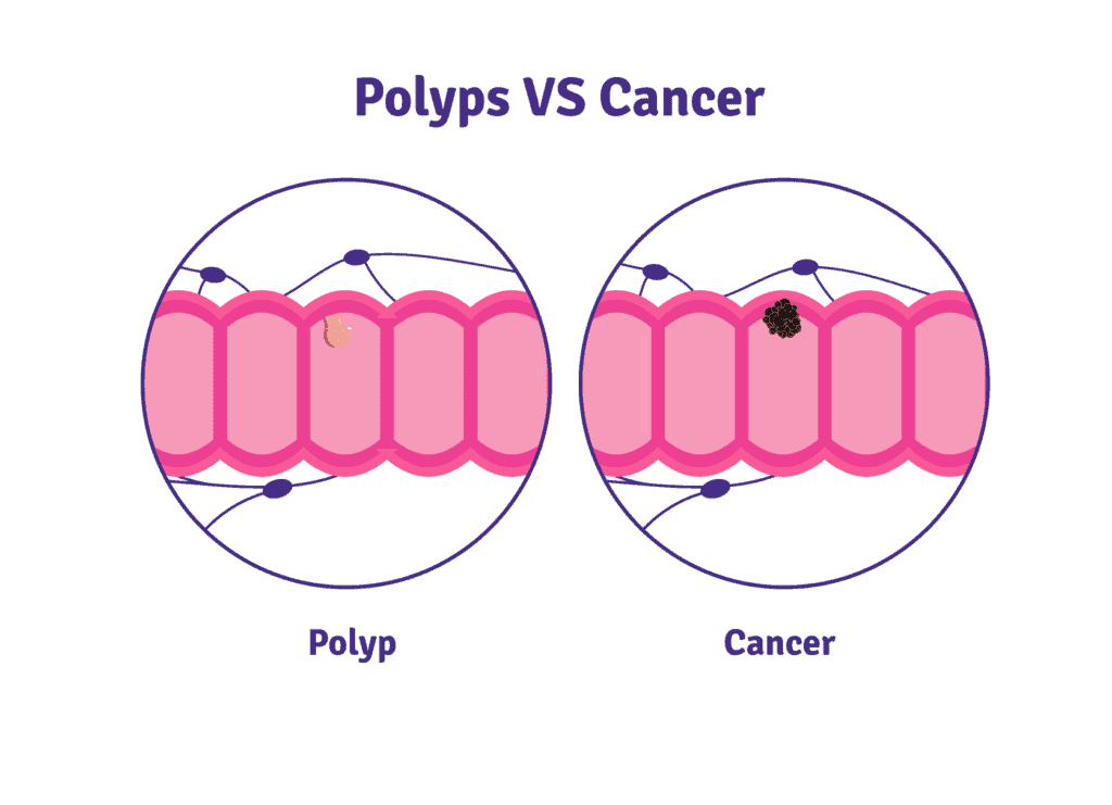 Colon Cancer Canadian Digestive Health Foundation
