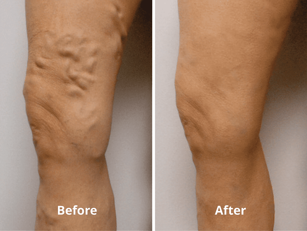 Vein Specialist Vein Clinic Arizona The Vein Center of Arizona