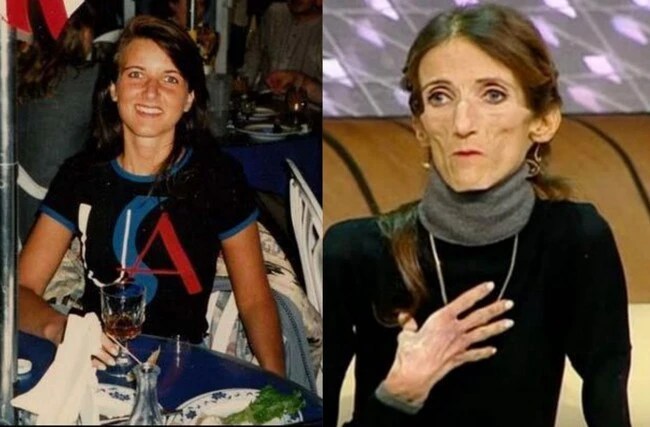 Top 10 Skinniest People In The World