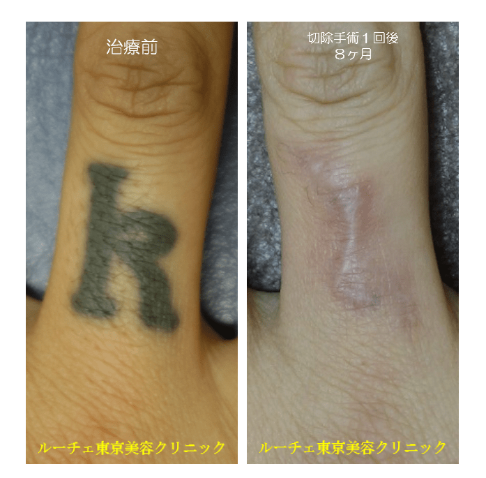 指のタトゥーを切除しました。 ルーチェ東京美容クリニックピコレーザータトゥー消すブログ エンライトンⅢ