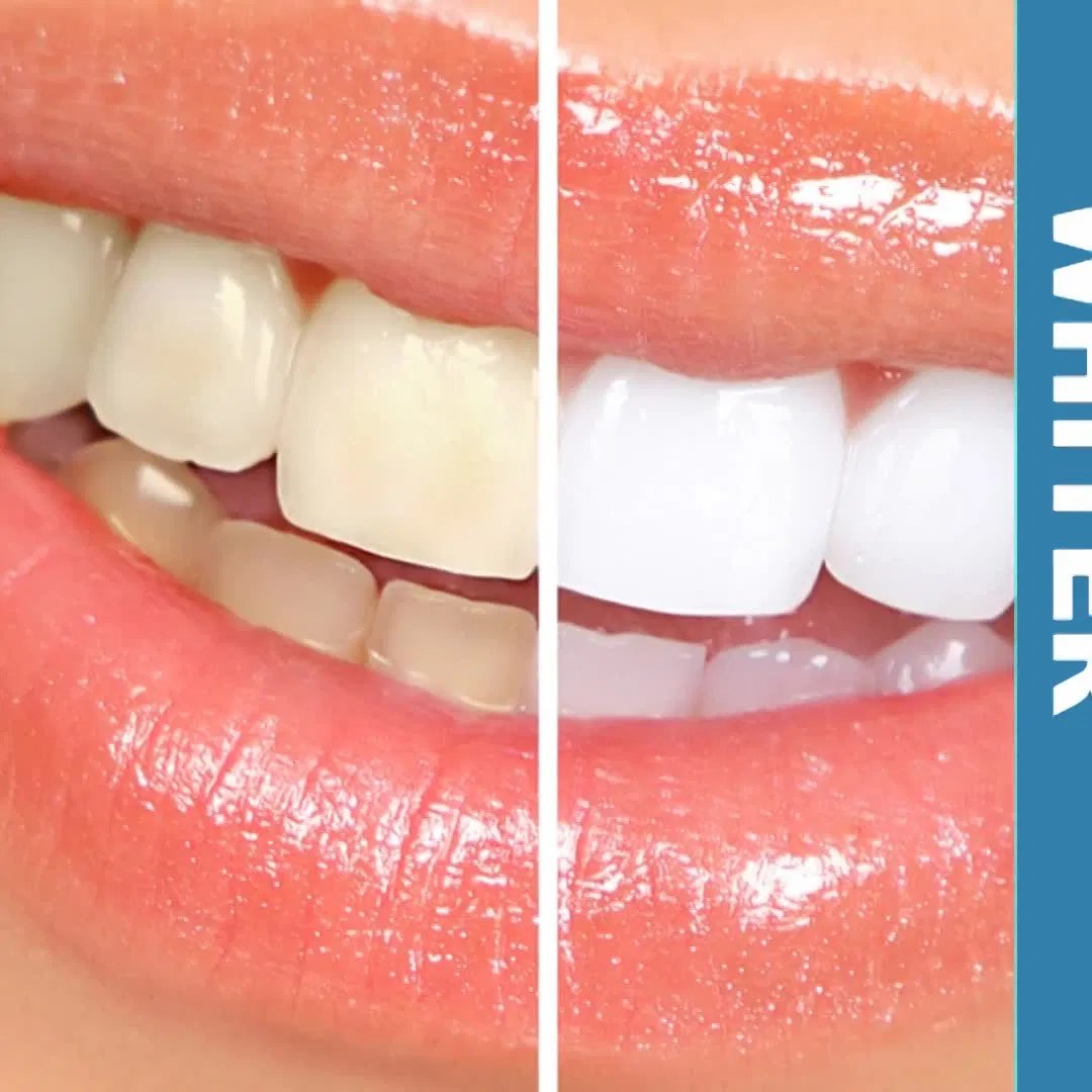  Teeth Whitening Training