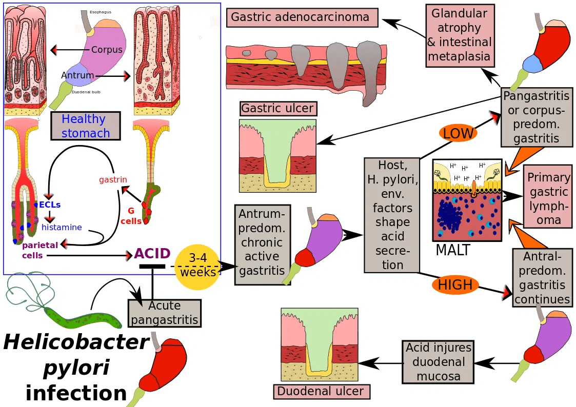 Overview of pathology caused by Helicobacter pylori SciMeditor