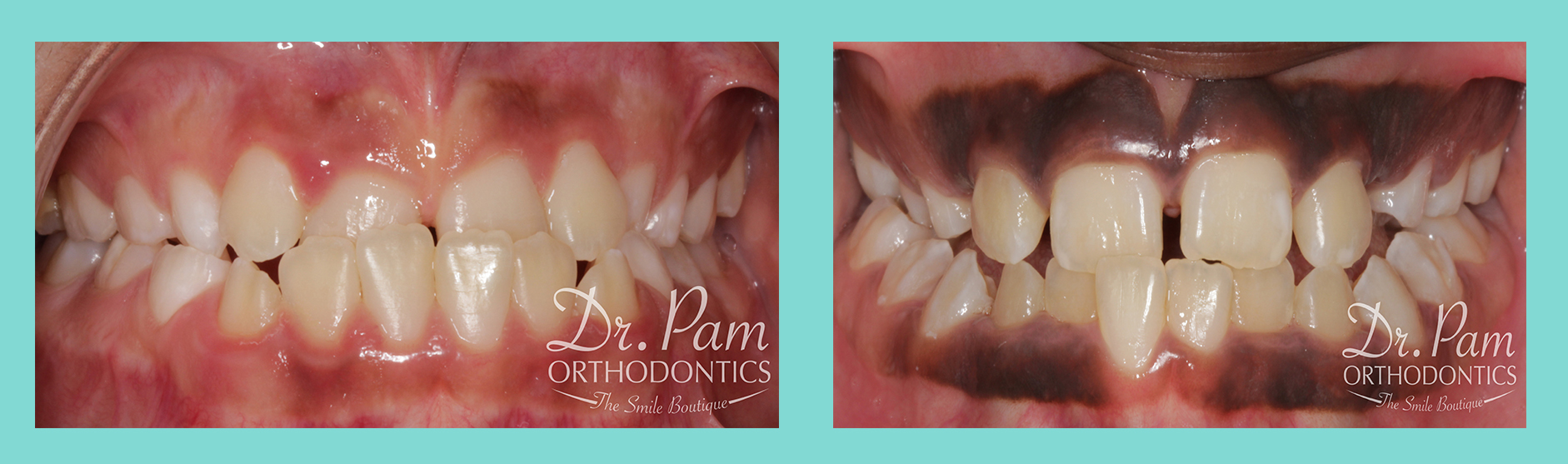 Orthodontics 101 Dr. Pam Orthodontics