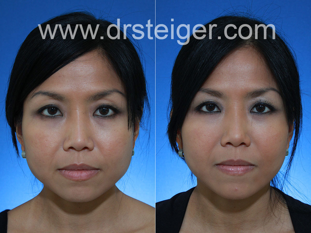 botox for jaw reduction